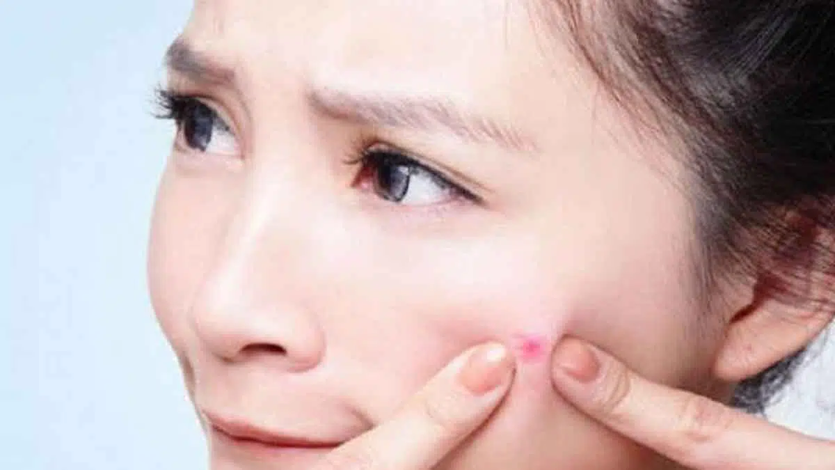 5 Cara Cegah Jerawat Saat Menjelang Menstruasi