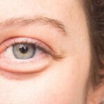 6 Cara Mudah Hilangkan Kantung Mata