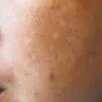 Flek Hitam di Pipi Bikin Kurang Percaya Diri, Gunakan 3 Bahan Alami ini