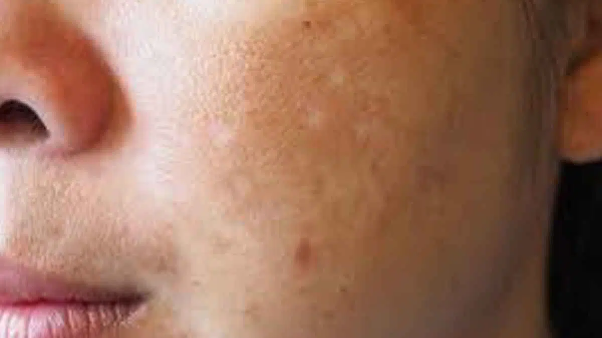 Flek Hitam di Pipi Bikin Kurang Percaya Diri, Gunakan 3 Bahan Alami ini