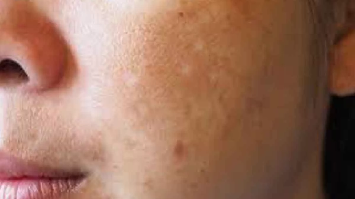 Flek Hitam di Pipi Bikin Kurang Percaya Diri, Gunakan 3 Bahan Alami ini