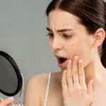 Ada Bekas Koreng di Wajah? Yuk Atasi dengan 4 Cara Alami Ini