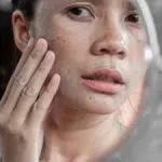 Atasi Flek Hitam pada Wajah dengan 5 Cara Alami