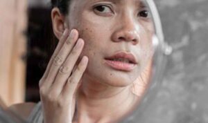 Atasi Flek Hitam pada Wajah dengan 5 Cara Alami