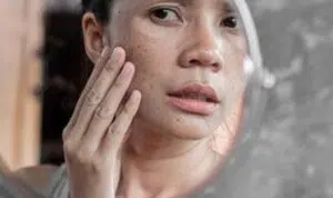 Atasi Flek Hitam pada Wajah dengan 5 Cara Alami