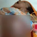 Bayi Lahir Tanpa Anus di Sampang, Perut Makin Besar