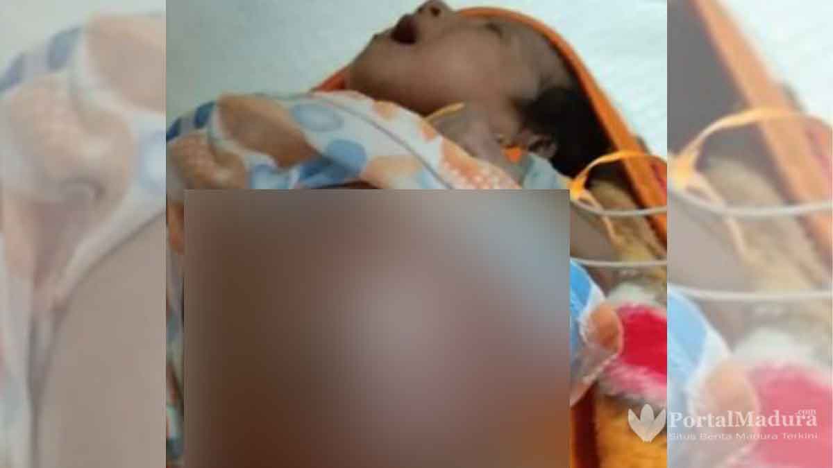Bayi Lahir Tanpa Anus di Sampang, Perut Makin Besar