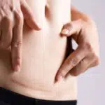 Berikut Tips Rawat Luka Jahitan Pasca Operasi Agar Tak Timbul Bekas