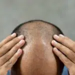 Bosan Rambut Botak? 9 Cara Alami Ini Cepat Tumbuhkan Rambut