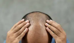 Bosan-Rambut-Botak-9-Cara-Alami-Ini-Cepat-Tumbuhkan-Rambut