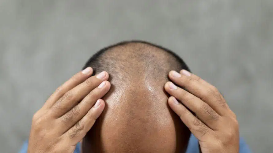 Bosan-Rambut-Botak-9-Cara-Alami-Ini-Cepat-Tumbuhkan-Rambut