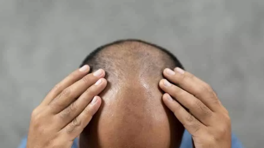 Bosan Rambut Botak? 9 Cara Alami Ini Cepat Tumbuhkan Rambut