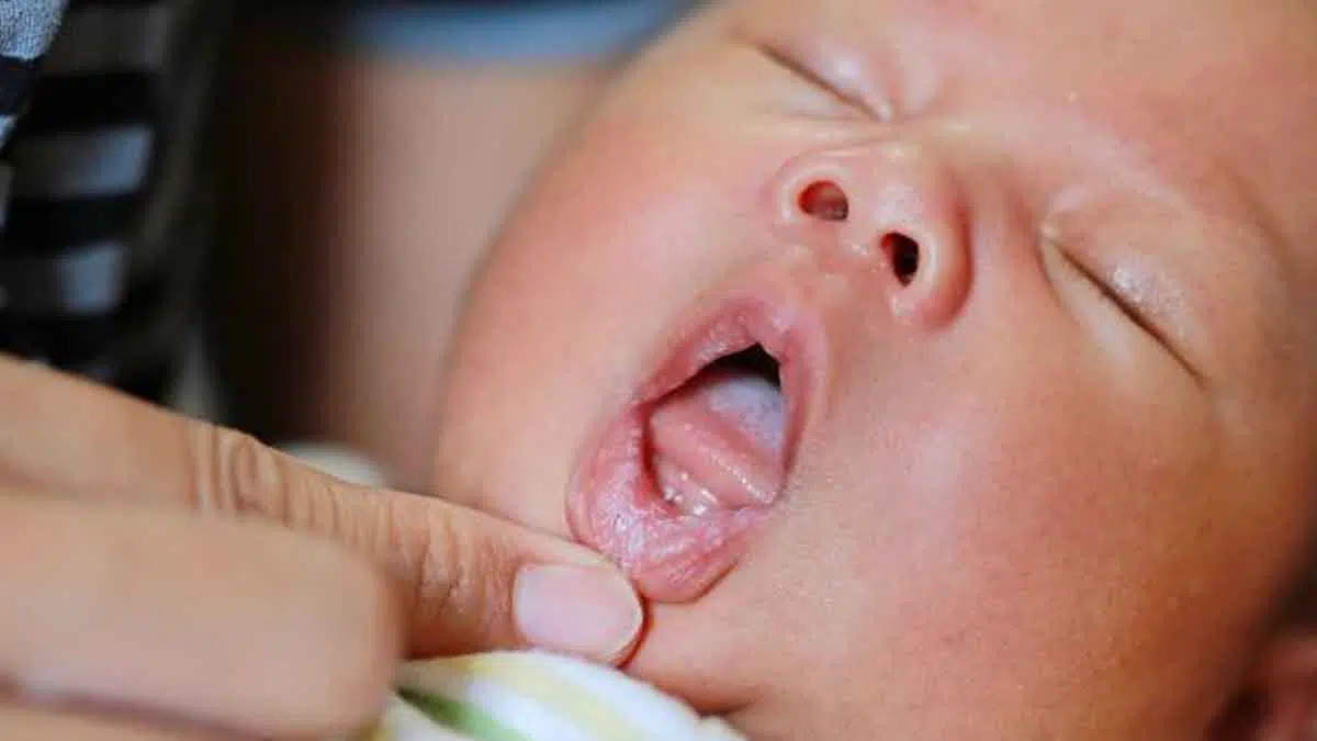 Bunda, Kenali Tanda-Tanda Tumbuh Gigi pada Bayi