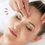 Sederet Khasiat Akupuntur Bagi Kecantikan Kulit