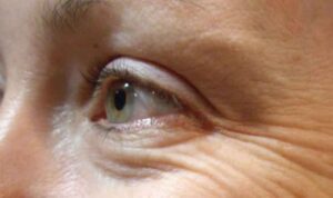 Tanpa Skin Care, Hilangkan Keriput di Mata dengan 5 Cara Ini