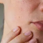 5 Hal yang Tak Boleh Dilakukan Pemilik Kulit Sensitif