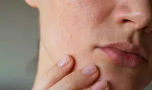 5 Hal yang Tak Boleh Dilakukan Pemilik Kulit Sensitif