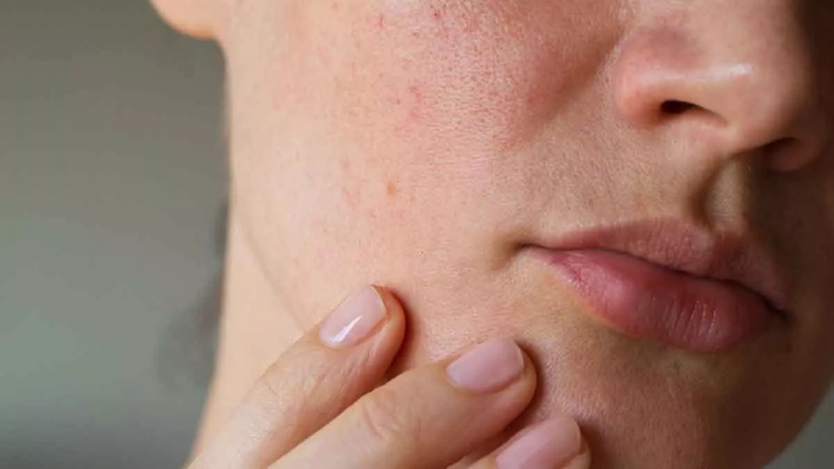 5 Hal yang Tak Boleh Dilakukan Pemilik Kulit Sensitif