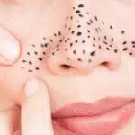 Ternyata Bintik Hitam di Hidung Tak Selalu Komedo, Lantas Apa?