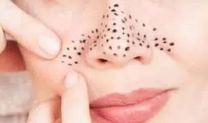 Ternyata-Bintik-Hitam-di-Hidung-Tak-Selalu-Komedo,-Lantas-Apa