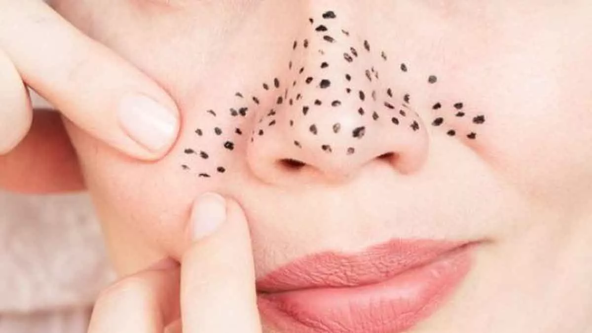 Ternyata Bintik Hitam di Hidung Tak Selalu Komedo, Lantas Apa?