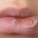 Bibir Kering Saat Puasa? Lakukan 6 Cara Mudah Ini