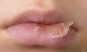Bibir Kering Saat Puasa? Lakukan 6 Cara Mudah Ini