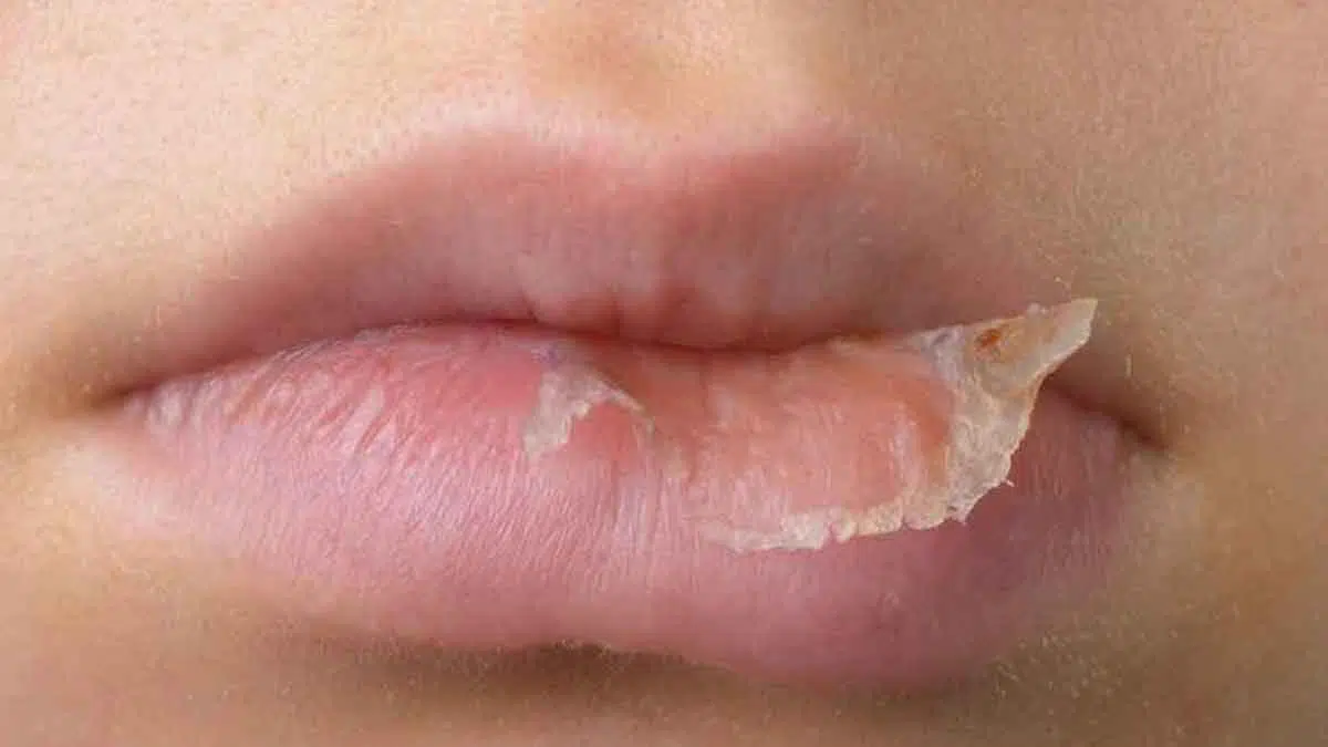 Bibir Kering Saat Puasa? Lakukan 6 Cara Mudah Ini