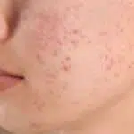 Pudarkan Noda Bekas Jerawat dengan 5 Cara Ini