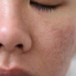 Wajib Tahu, Ini 5 Penyebab Rusaknya Skin Barrier