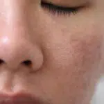 Wajib Tahu, Ini 5 Penyebab Rusaknya Skin Barrier