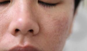 Wajib Tahu, Ini 5 Penyebab Rusaknya Skin Barrier