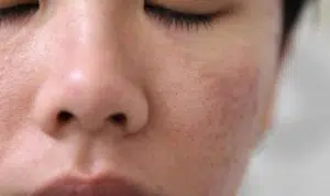 Wajib Tahu, Ini 5 Penyebab Rusaknya Skin Barrier
