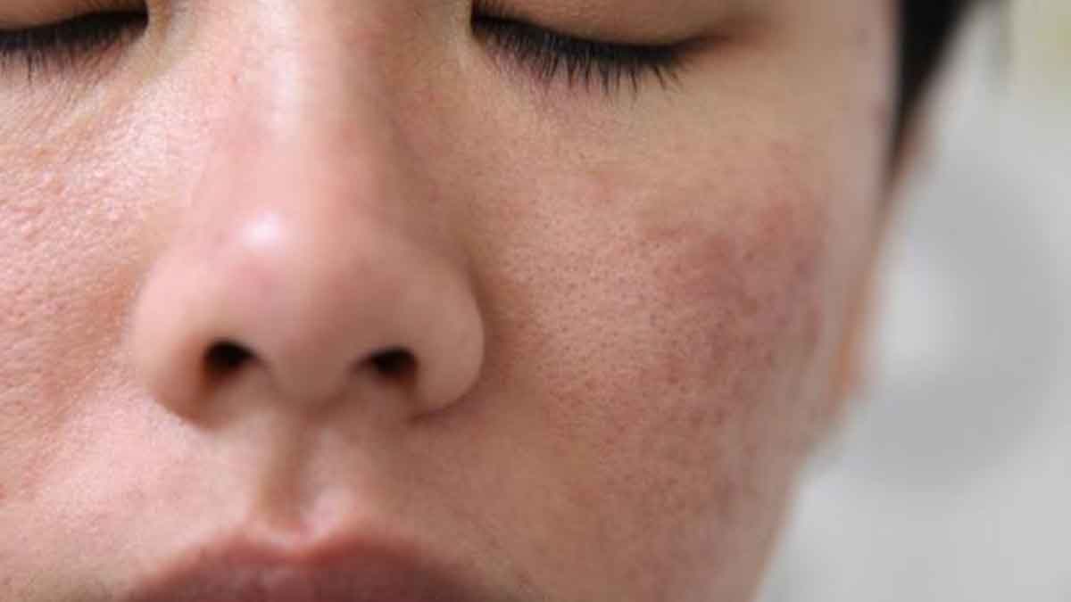 Wajib Tahu, Ini 5 Penyebab Rusaknya Skin Barrier