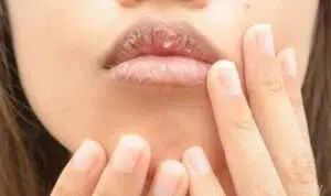 3 Kandungan Pelembap yang Bisa Lindungi Bibir Kering