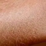 Guys, Ini 5 Cara Ampuh Atasi Kulit Bersisik