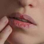 Alami Bibir Kering dan Pecah-pecah? Ini 5 Penyebabnya