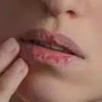 Alami Bibir Kering dan Pecah-pecah? Ini 5 Penyebabnya