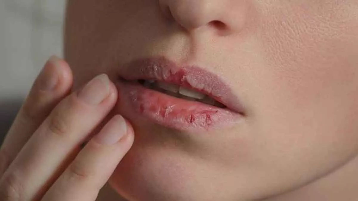Alami Bibir Kering dan Pecah-pecah? Ini 5 Penyebabnya