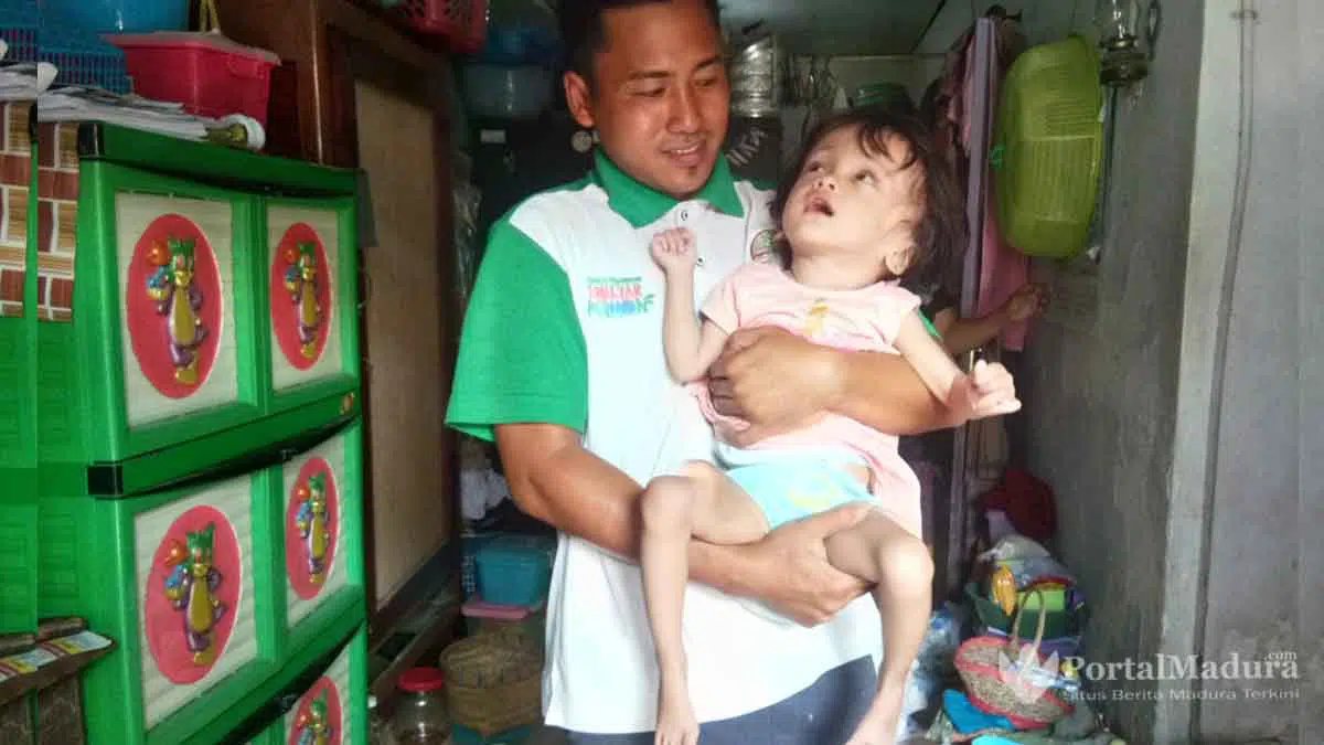 Bocah Keluarga Tak Mampu Menderita Hidrosefalus di Sampang
