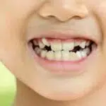 Lakukan ini untuk Atasi Gigi Anak Tumbuh Berantakan
