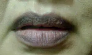 Cegah Bibir Menghitam dengan 5 Cara Ini
