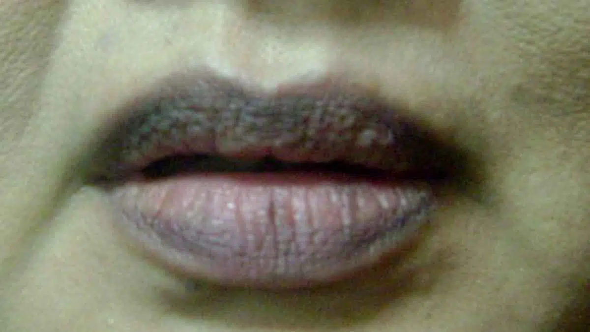 Cegah Bibir Menghitam dengan 5 Cara Ini