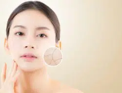 5 Cara Menghidrasi Kulit Wajah Bagi Pemilik Kulit Kering