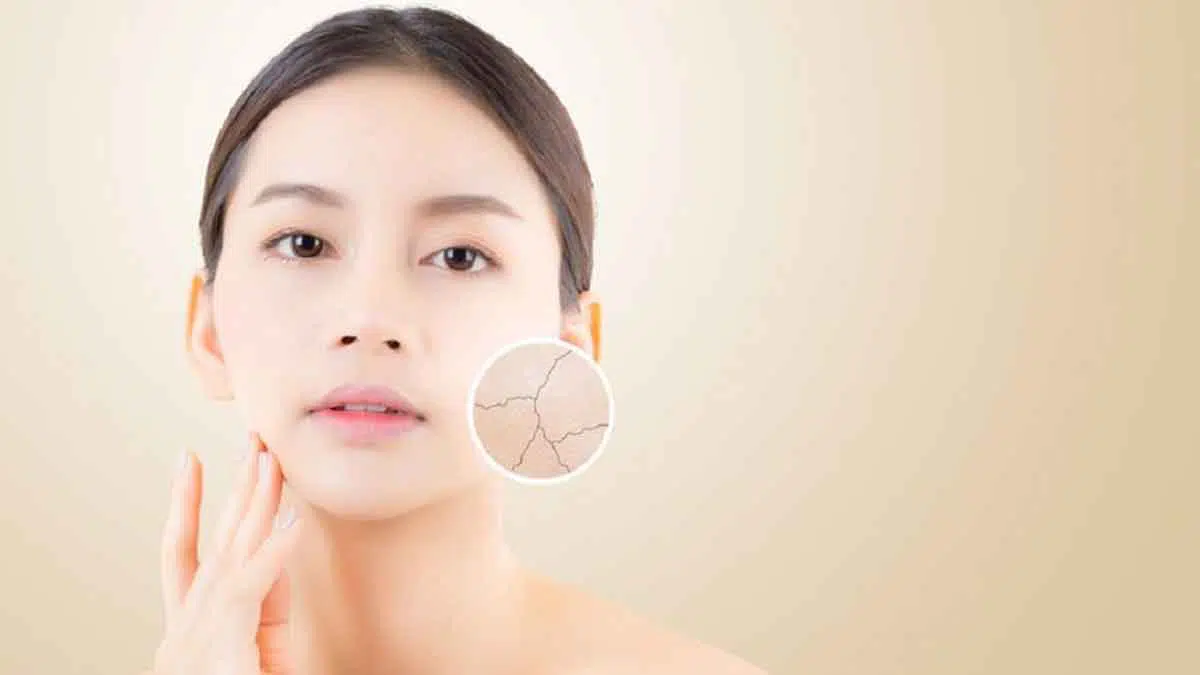 5 Cara Menghidrasi Kulit Wajah Bagi Pemilik Kulit Kering