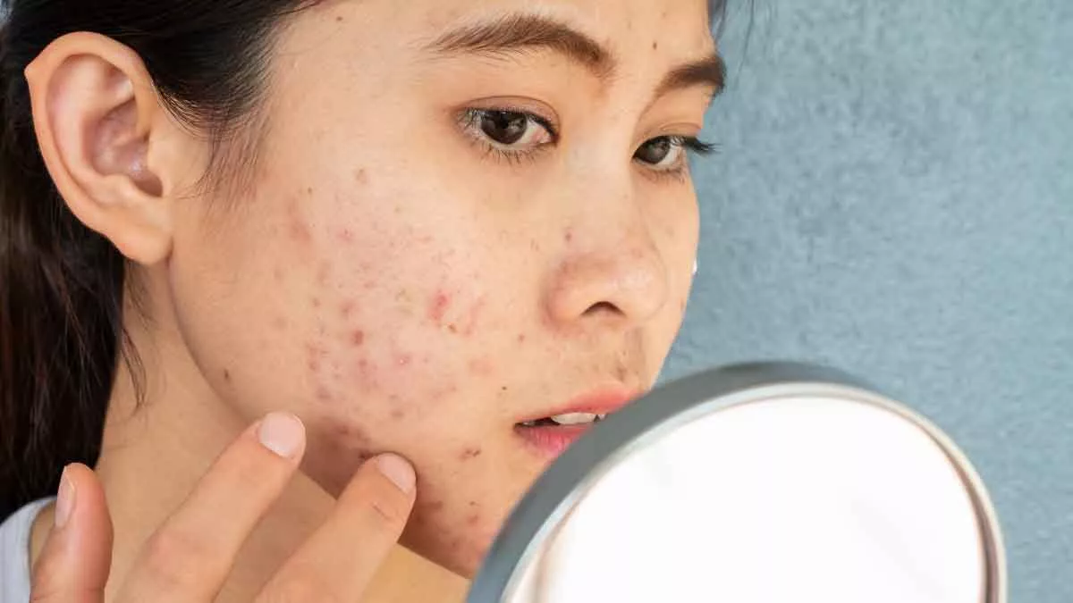 Samarkan Bekas Jerawat dengan 5 Kandungan Skincare Ini