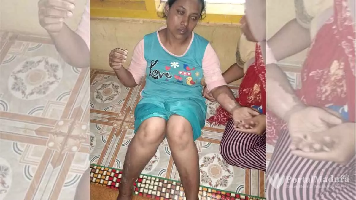 Istri dan Putri Pemilik Toko Alami Luka Bakar