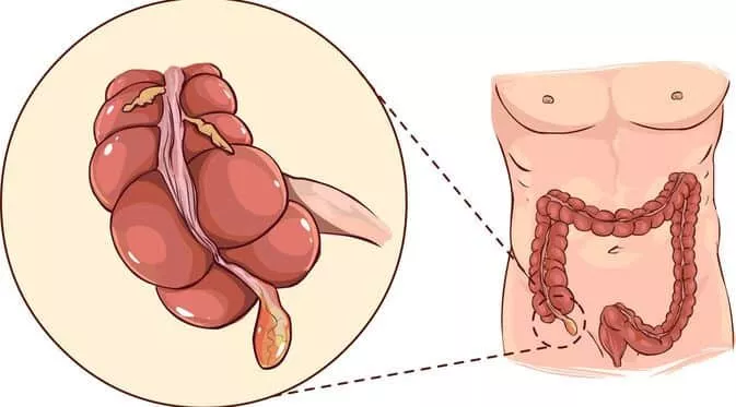Penyebab Radang Usus Buntu dan Cara Mengobatinya, Termasuk Perawatan Rumahannya