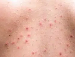 Ini Penyebab Jerawat Di Punggung dan 5 Cara Ampuh Menghilangkannya
