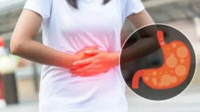 Asam Lambung Naik? Ini Penyebabnya dan 4 Cara Mengatasinya